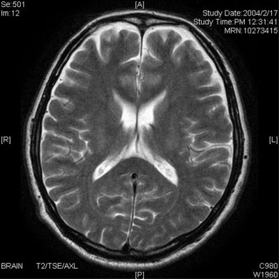 脳梗塞や認知症の診断に使われるMRIの画像